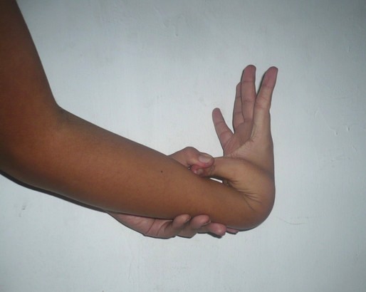 Thumb hypermobility - Image credit - "Hypermobility-02" by Rollcloud is marked with CC0 1.0.